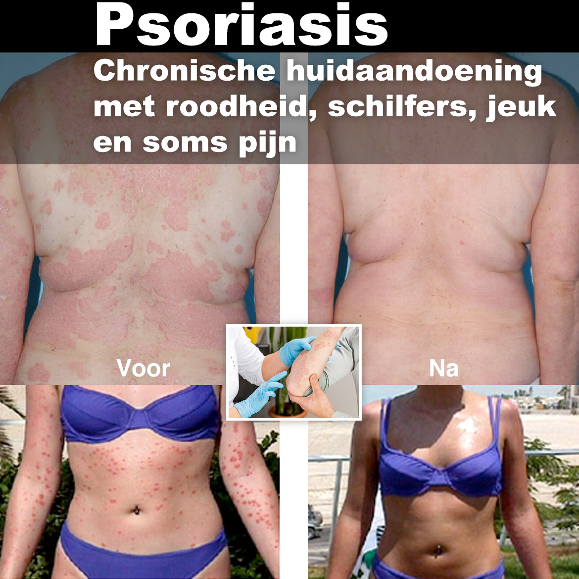 psoriasis